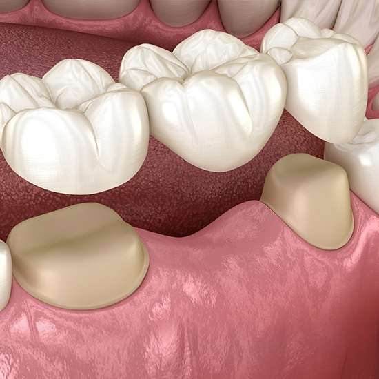 illustration of dental bridge
