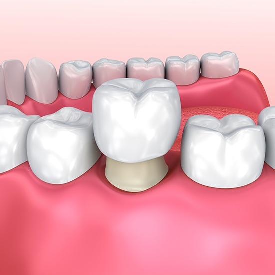illustration of single dental crown