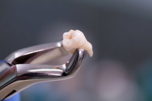 Your Family Dentist in Evergreen: Best Time to Remove Wisdom Teeth