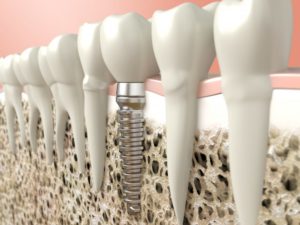 5 Facts About Dental Implants in Evergreen You Should Consider