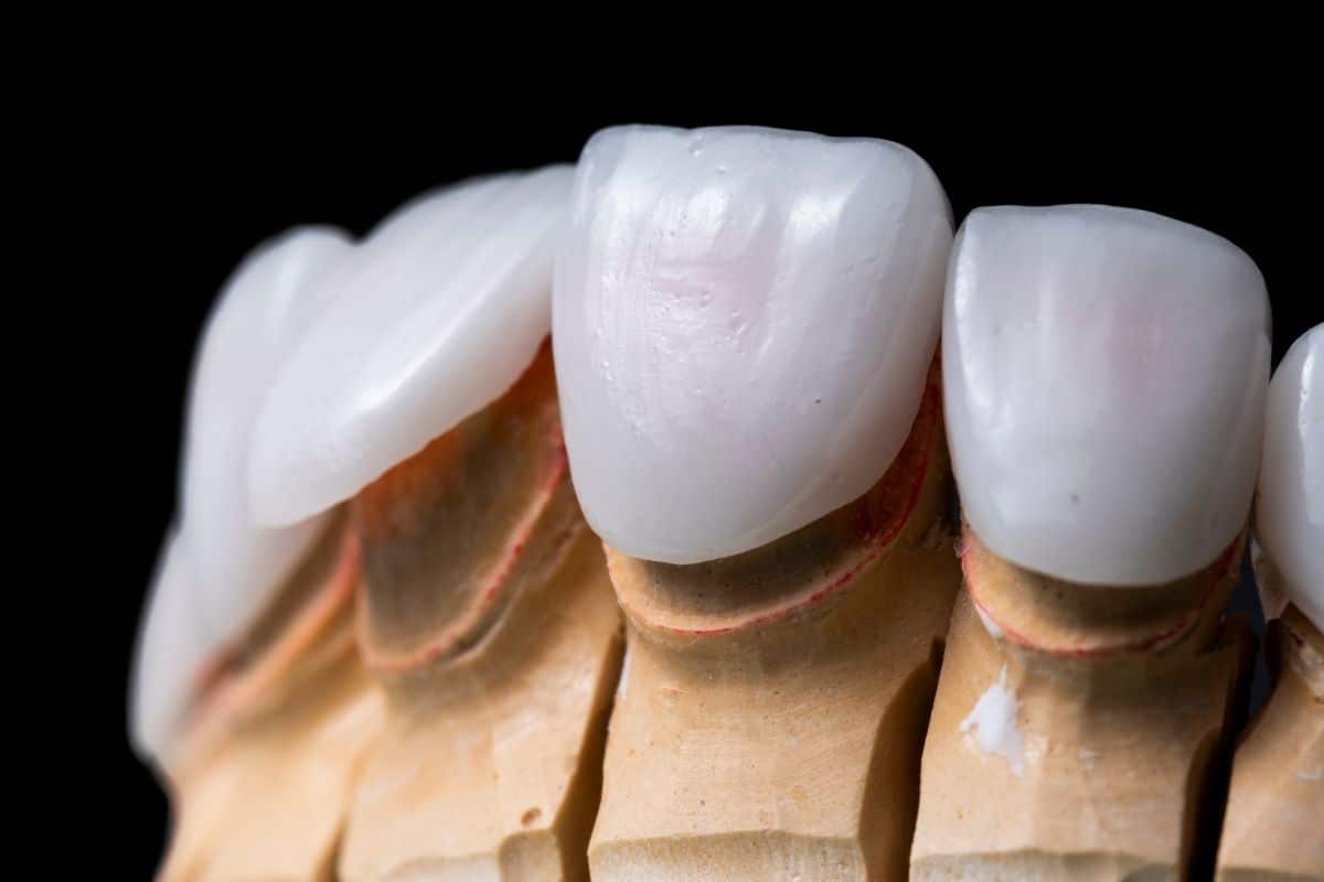 6 Amazing Advantages Of Dental Veeners