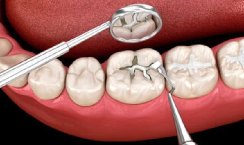 tooth-colored fillings & benefits
