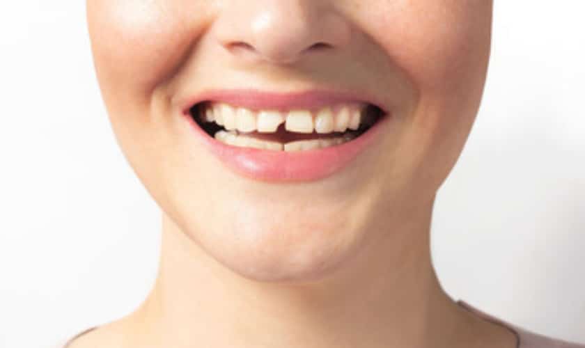 cavity-or-broken-teeth