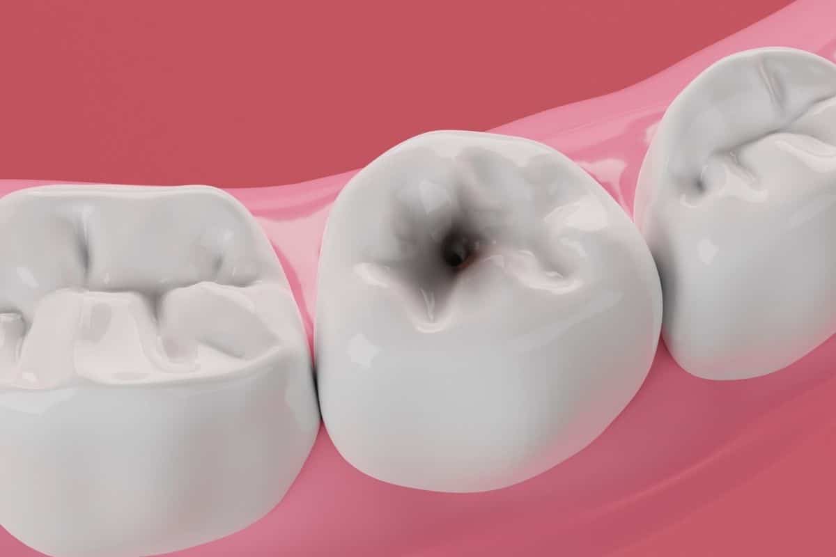 How To Get Rid Of Cavities? Symptoms, Causes, Treatment & Prevention