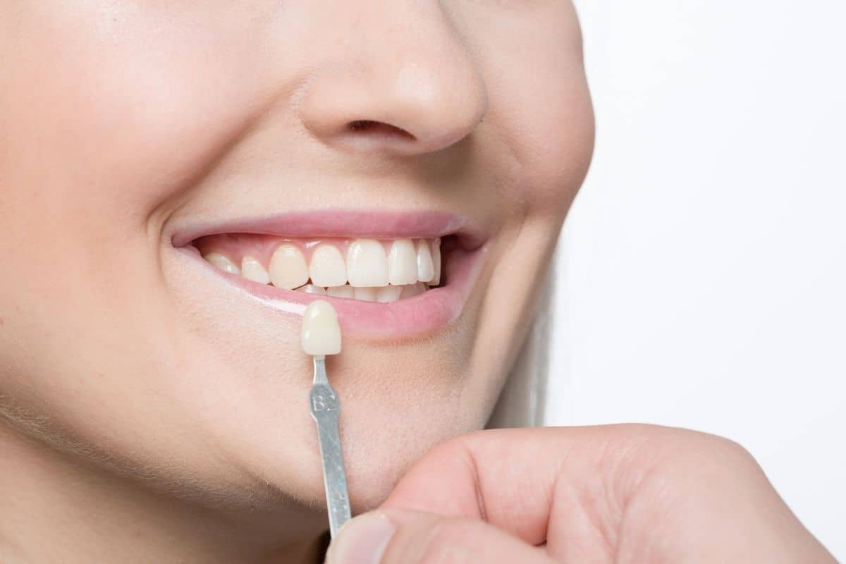 How Long Do Veneers Last?
