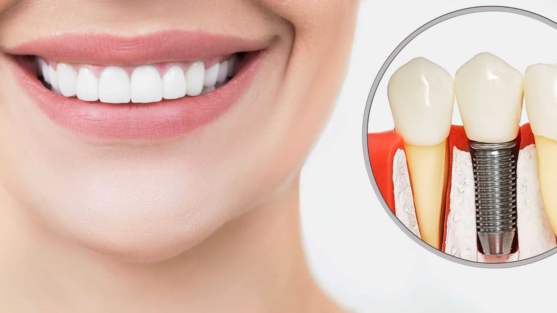 The Power of Dental Implants: A Permanent Smile Solution