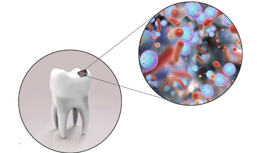 Ticking Time Bomb: Should You Wait to Fill a Cavity? Expert Advice from Evergreen Dental Group