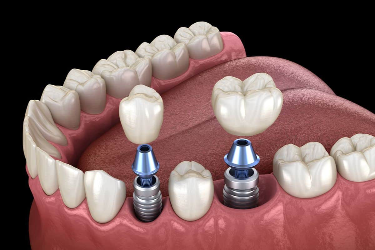 The Benefits of Dental Implants: Why They’re Worth the Investment