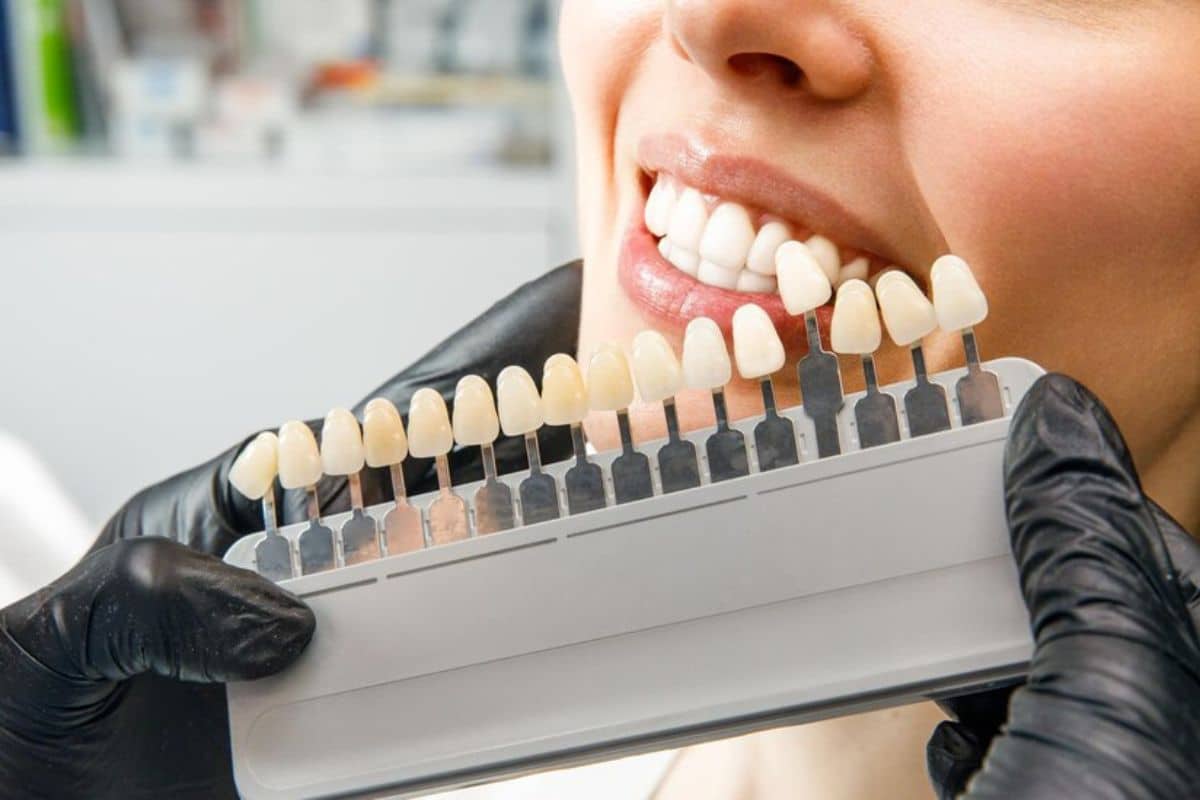 The Porcelain Veneer Procedure: Step-by-Step