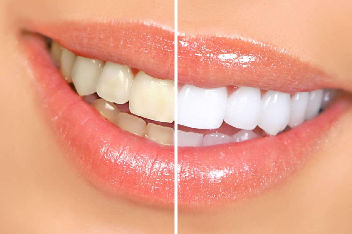 How to Choose the Right Teeth Whitening Product