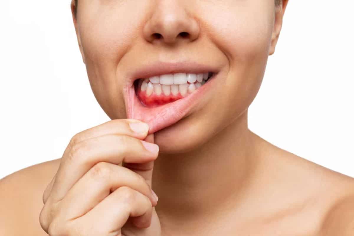 The Bidirectional Relationship Between Gum Disease and Diabetes