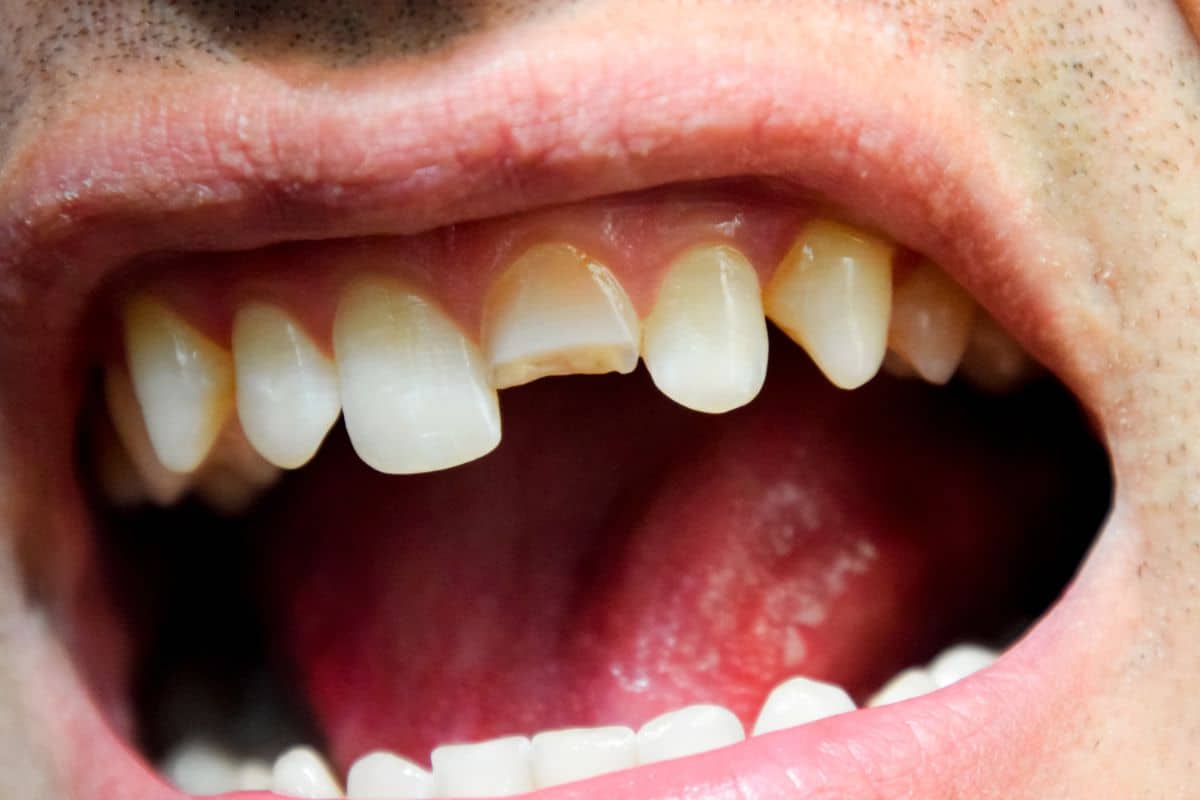 Knocked-Out Teeth in Teenagers: What to Do