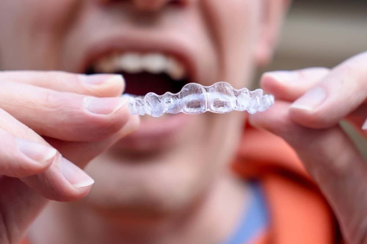 6 Factors That Affect the Duration of Invisalign Treatment