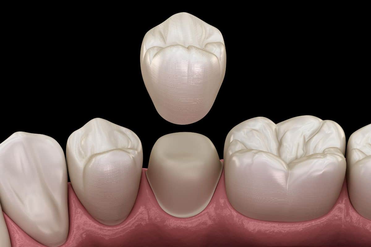 How Long Does the Same-Day Crown Process Typically Take?