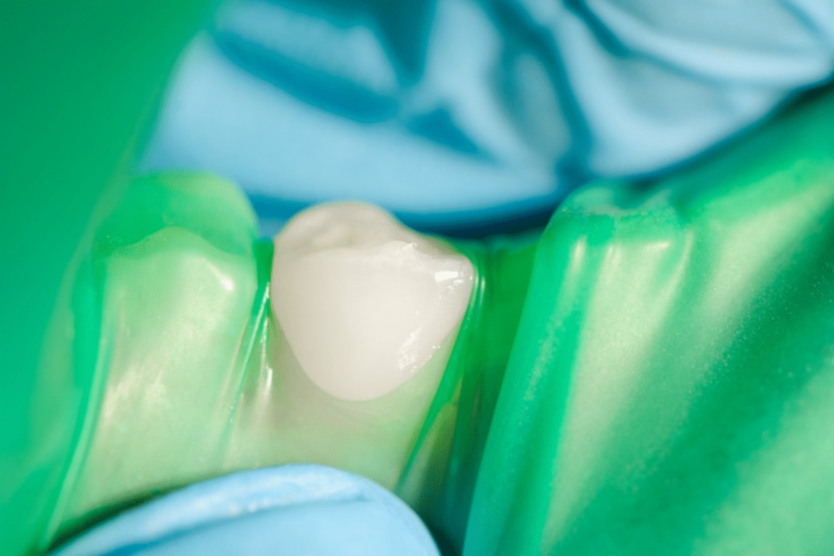 Can Tooth-Colored Fillings Be Whitened? Here’s What You Need to Know