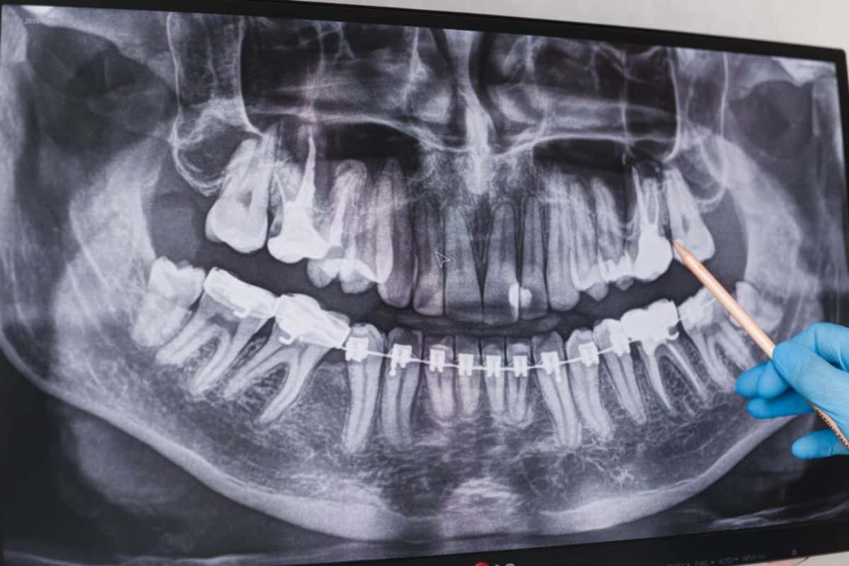 Wisdom Tooth Infection: Symptoms, Causes, and When to See a Dentist