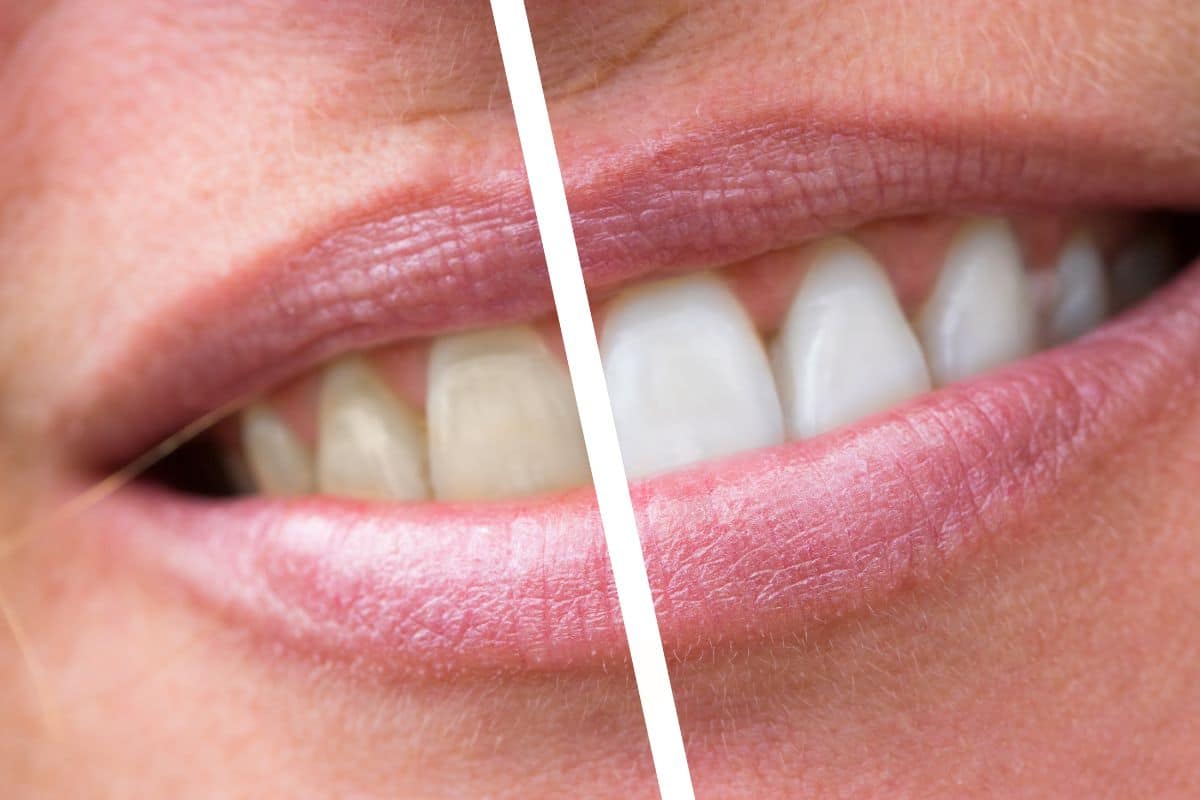 Is Teeth Whitening Safe for Enamel? Dentist-Approved Advice