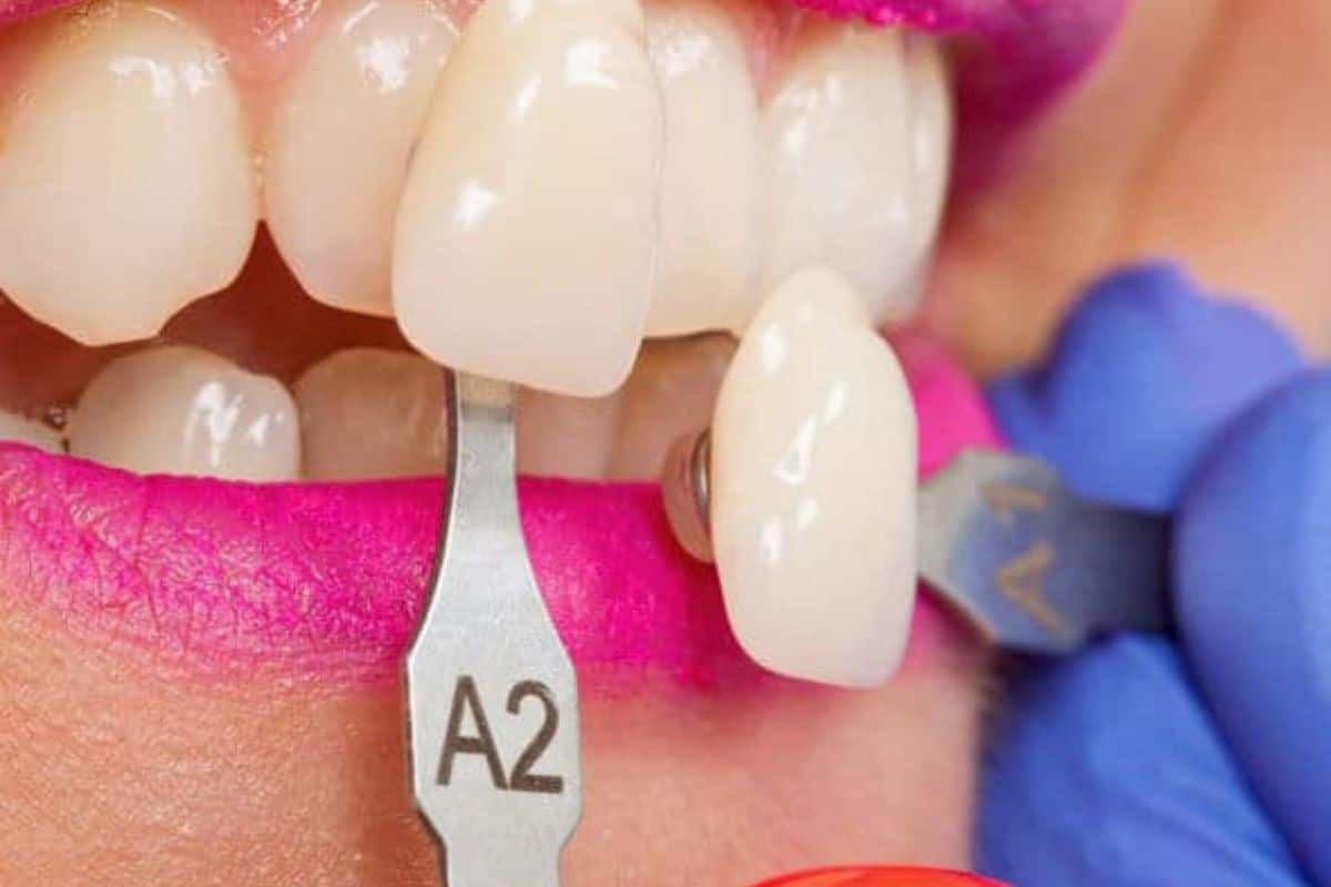 Are Veneers Bad for Your Teeth? Myths vs Facts Explained Clearly