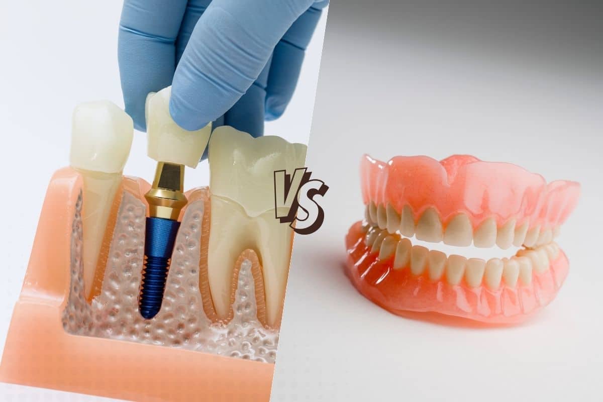 Dental Implants vs. Dentures: Which One Is Better for You?