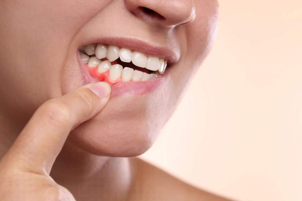 Early Signs of Gum Disease You Should Never Ignore
