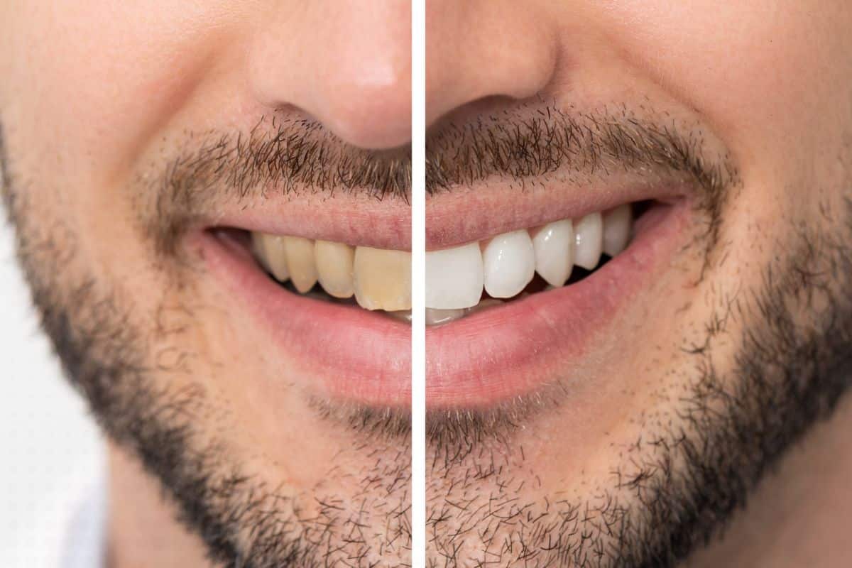What Causes Tooth Stains & How Whitening Helps