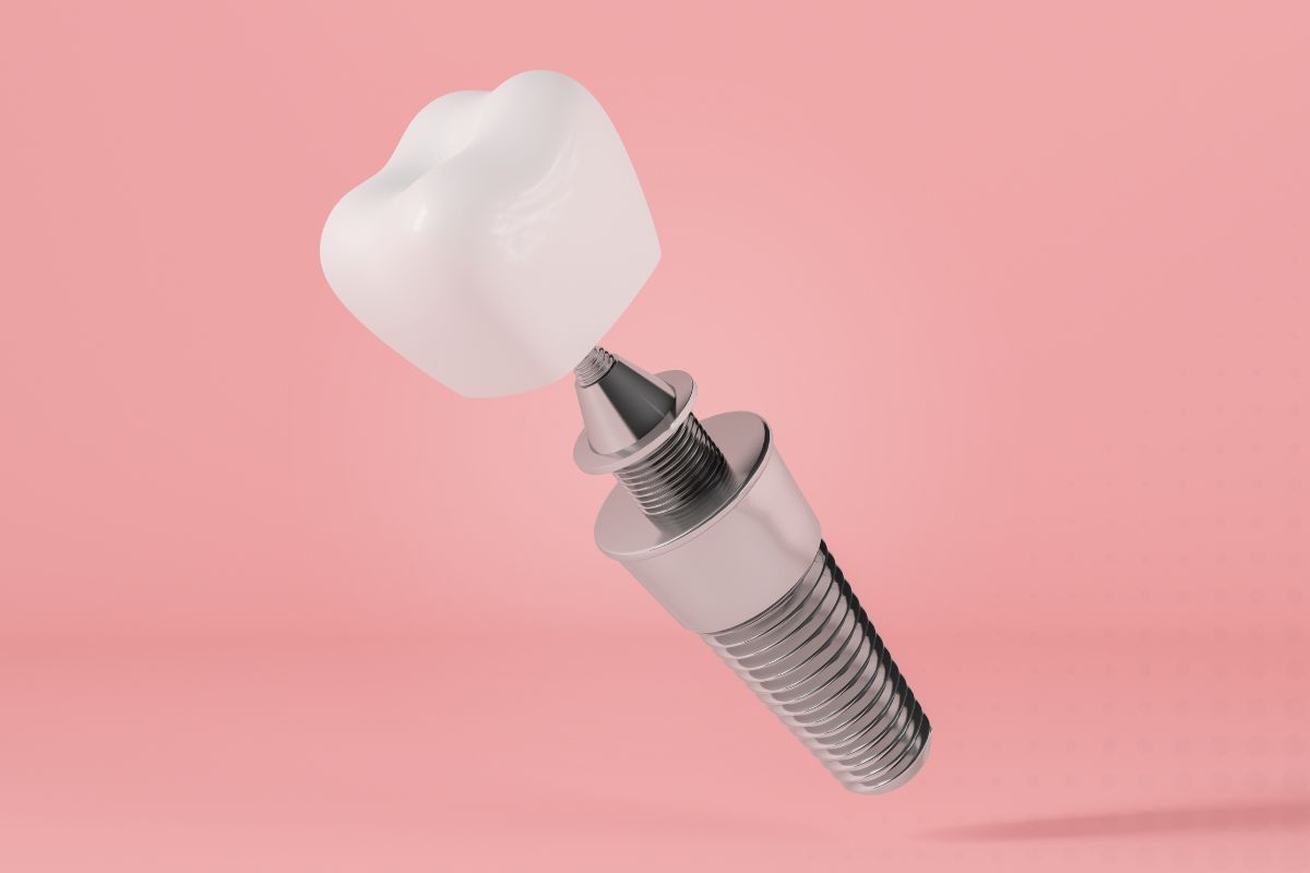 How to Care for Dental Implants for Long-Term Success