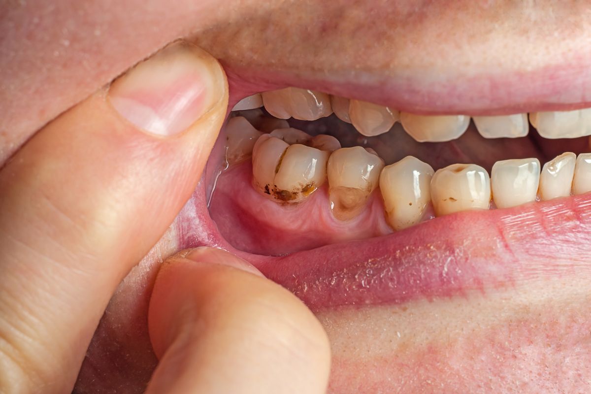 Cavities Without Pain: Why You Still Need Dental Treatment
