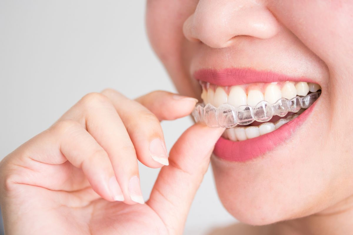Speech Issues with Invisalign: Myth or Reality?