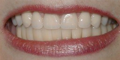 Cosmetic Dentistry After Treatment