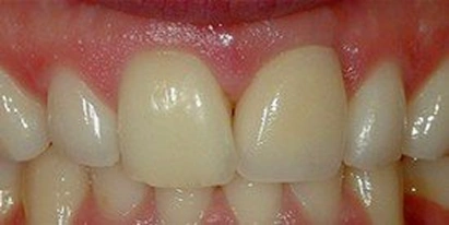 Dental Implant After Treatment