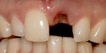 Dental Implant Before Treatment