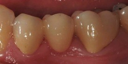Smile Gallery After Treatment