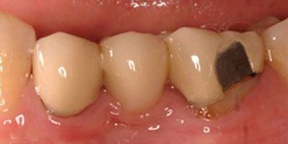 Smile Gallery Before Treatment