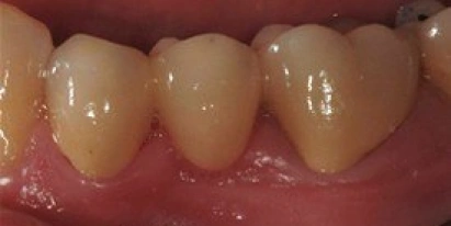 Dental Implant After Treatment
