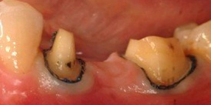 Dental Implant Before Treatment