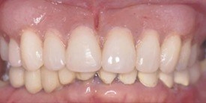 Dentures After Treatment