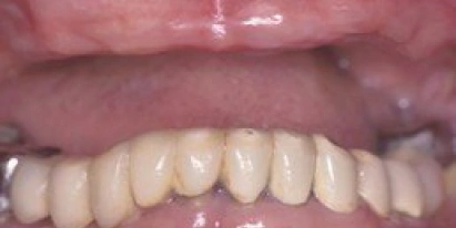 Dentures Before Treatment