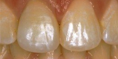 Veneers After Treatment