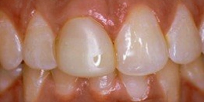 Veneers Before Treatment