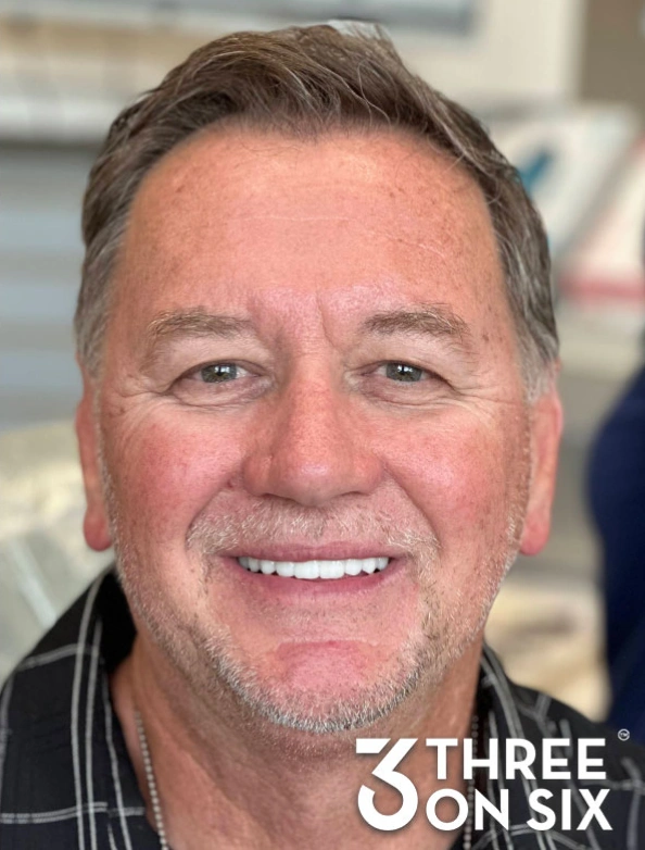 After 3-on-6 dental implant treatment with restored teeth and improved smile
