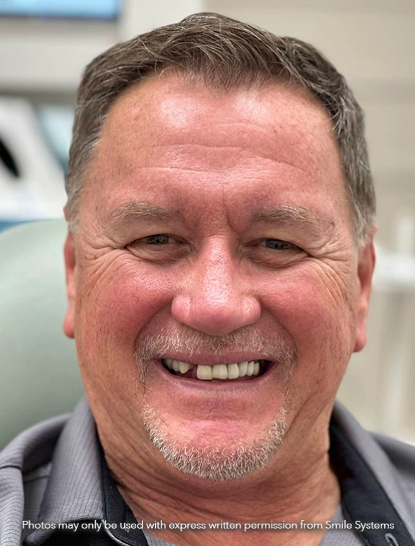Before 3-on-6 dental implant treatment showing tooth loss and worn teeth