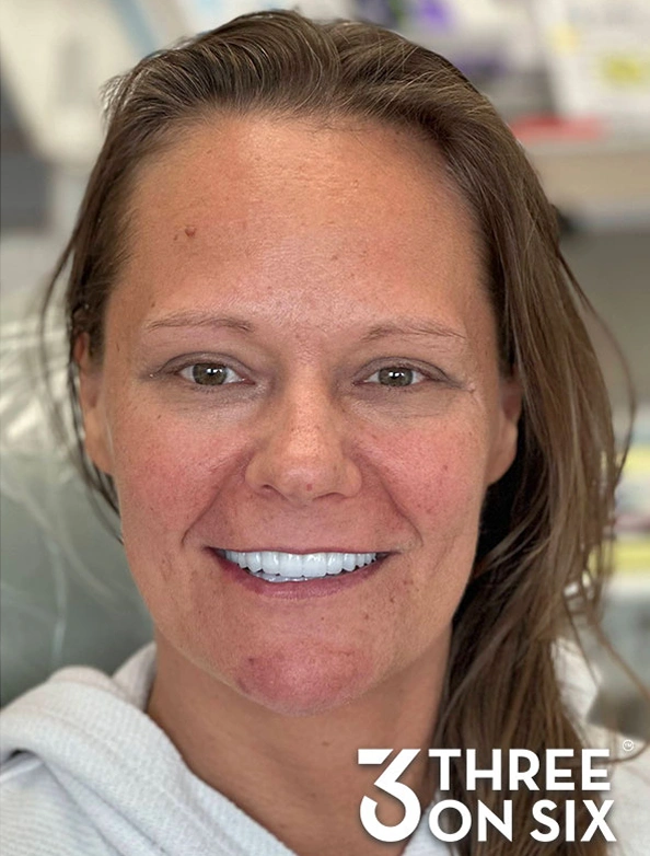 After 3-on-6 dental implant treatment with a complete, confident smile