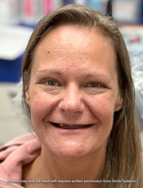 Before 3-on-6 dental implant treatment showing missing teeth