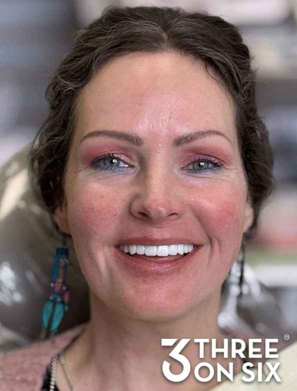 After 3-on-6 dental implant smile transformation with a restored smile
