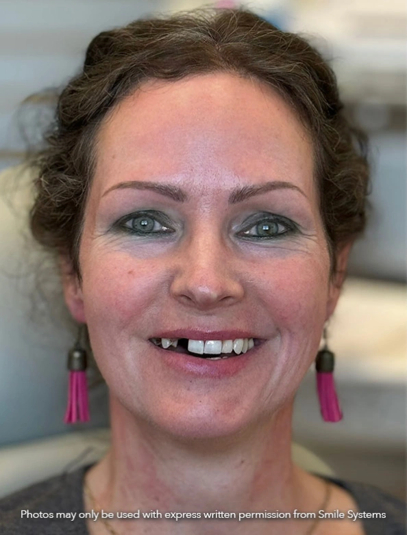 Before 3-on-6 dental implant smile transformation with missing and damaged teeth