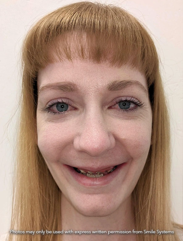 Before full mouth restoration showing worn and damaged teeth