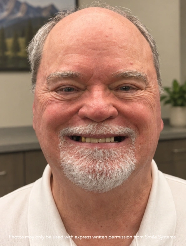 3-on-6-Whitening-Before