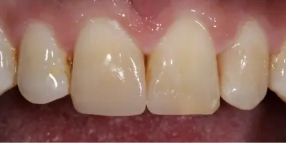 Close-up of four aligned front teeth showing successful orthodontic treatment results.