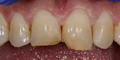 Crooked upper front teeth before orthodontic treatment in Evergreen, CO.