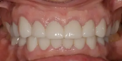 Straightened teeth after orthodontic treatment showing aligned front smile.